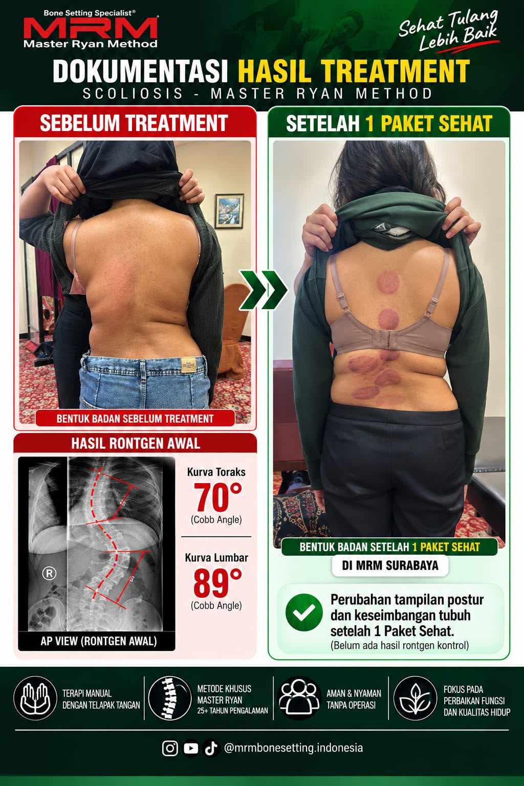 Hasil treatment scoliosis setelah 1 Paket Sehat - MRM Surabaya