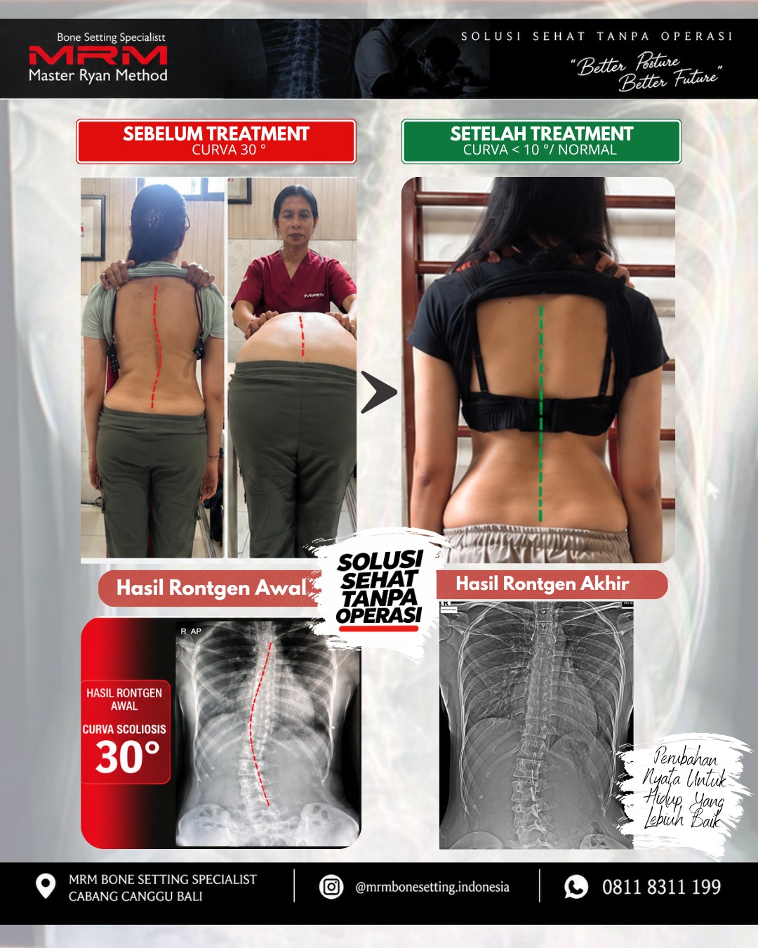 Hasil treatment scoliosis 30 derajat menjadi di bawah 10 derajat - MRM Bali